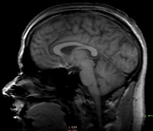 dalbrain1